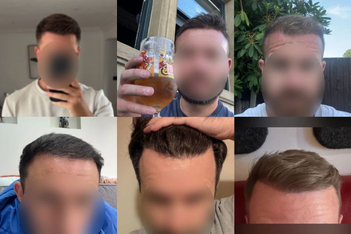 Hair Transplant Costs: Turkey vs the UK in 2026