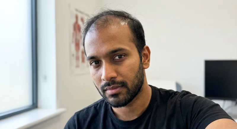 Arjun, 29, before FUE hair transplant showing crown thinning